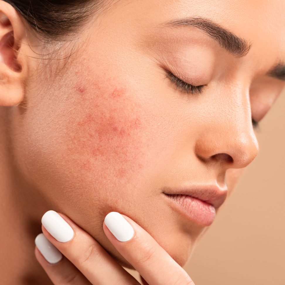 Acne Scarring treatments in Edina & Bloomington