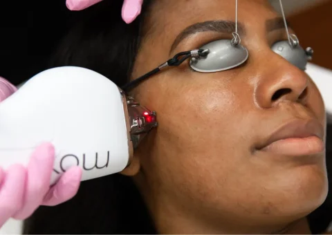 african american women getting skin rejuventation treatment on her cheek