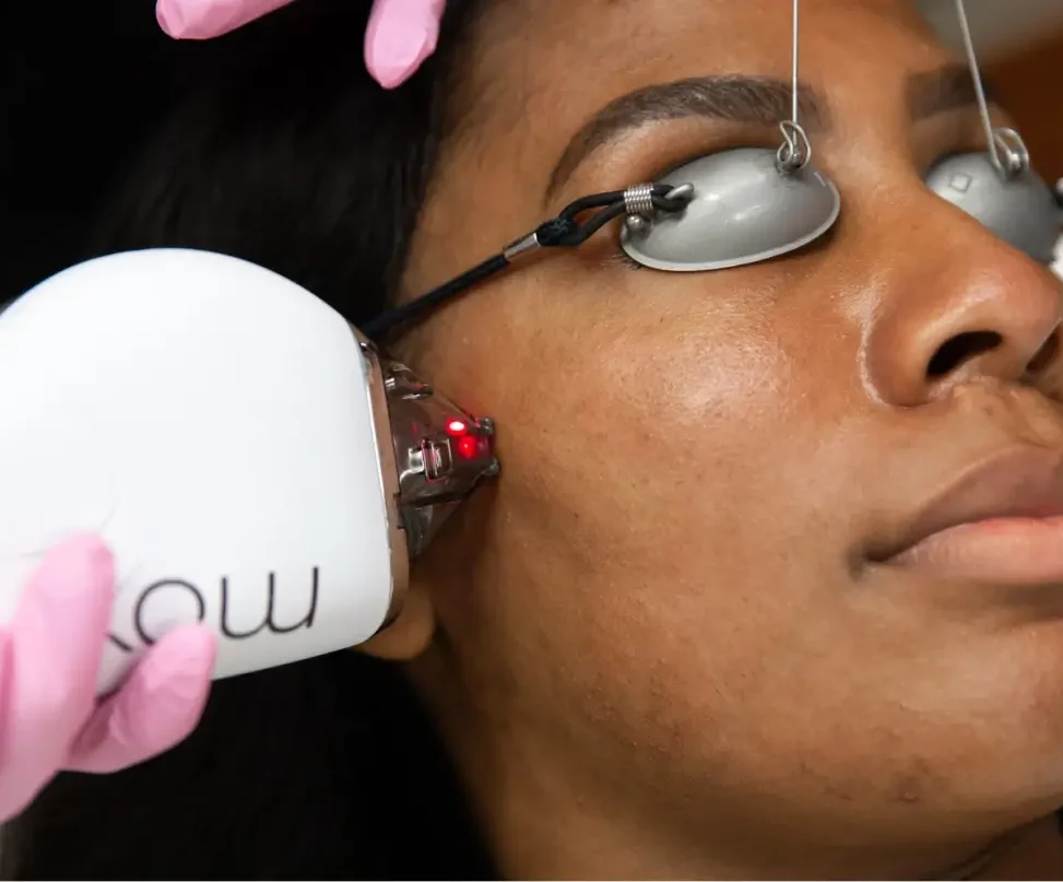 african american women getting skin rejuventation treatment on her cheek
