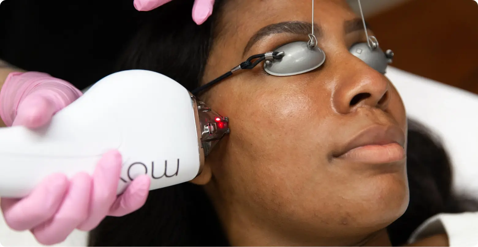 african american women getting skin rejuventation treatment on her cheek