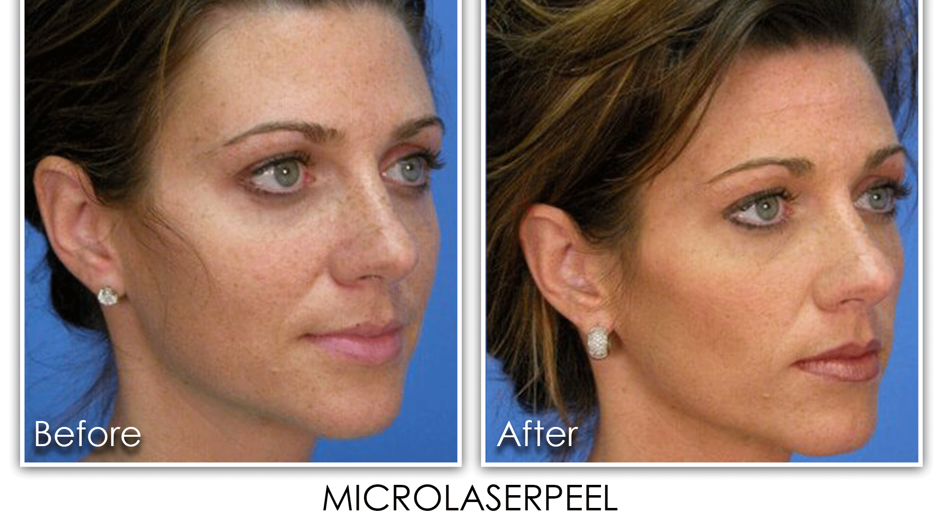 1 MicroLaserPeel - Skin Rejuvenation Clinic Skin Rejuvenation Clinic