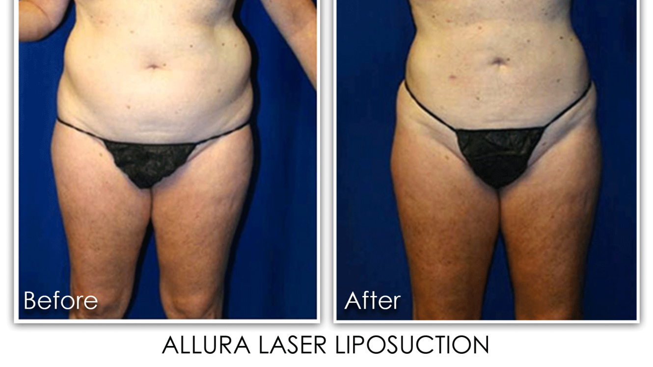 Before and after Allura Laser Liposuction Photos