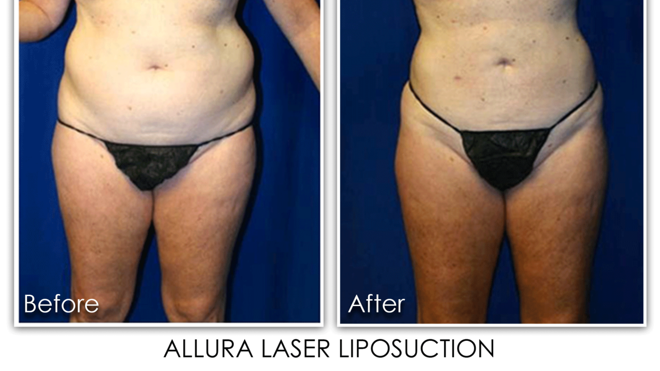 Before and after Allura Laser Liposuction Photos