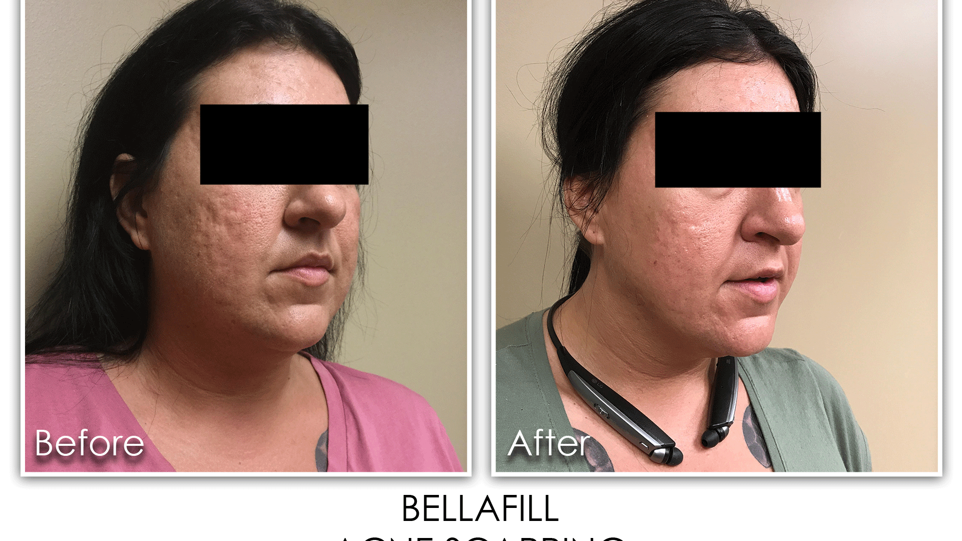 14 DERMAL FILLER ACNE SCARRING Skin Rejuvenation Clinic Skin