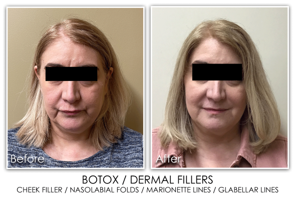 before and after of botox treatment