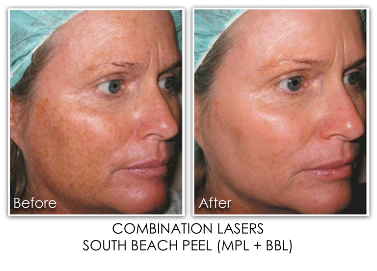 Combination Laser Treatments Skin Rejuvenation Clinic Skin