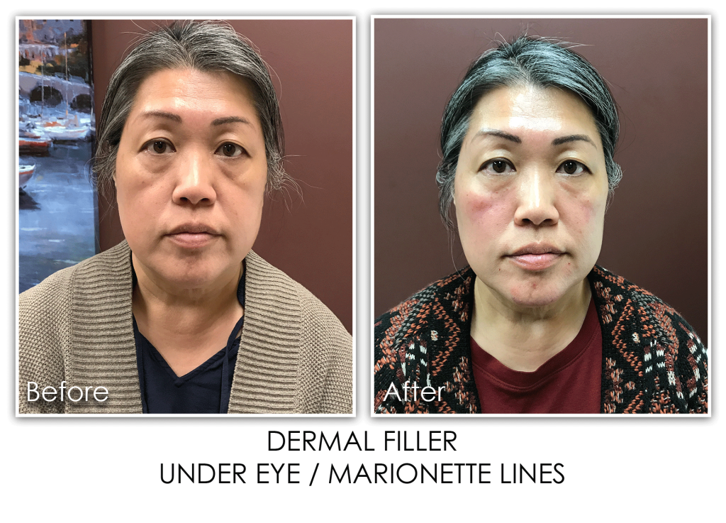 Lines Archives Skin Rejuvenation Clinic Skin Rejuvenation