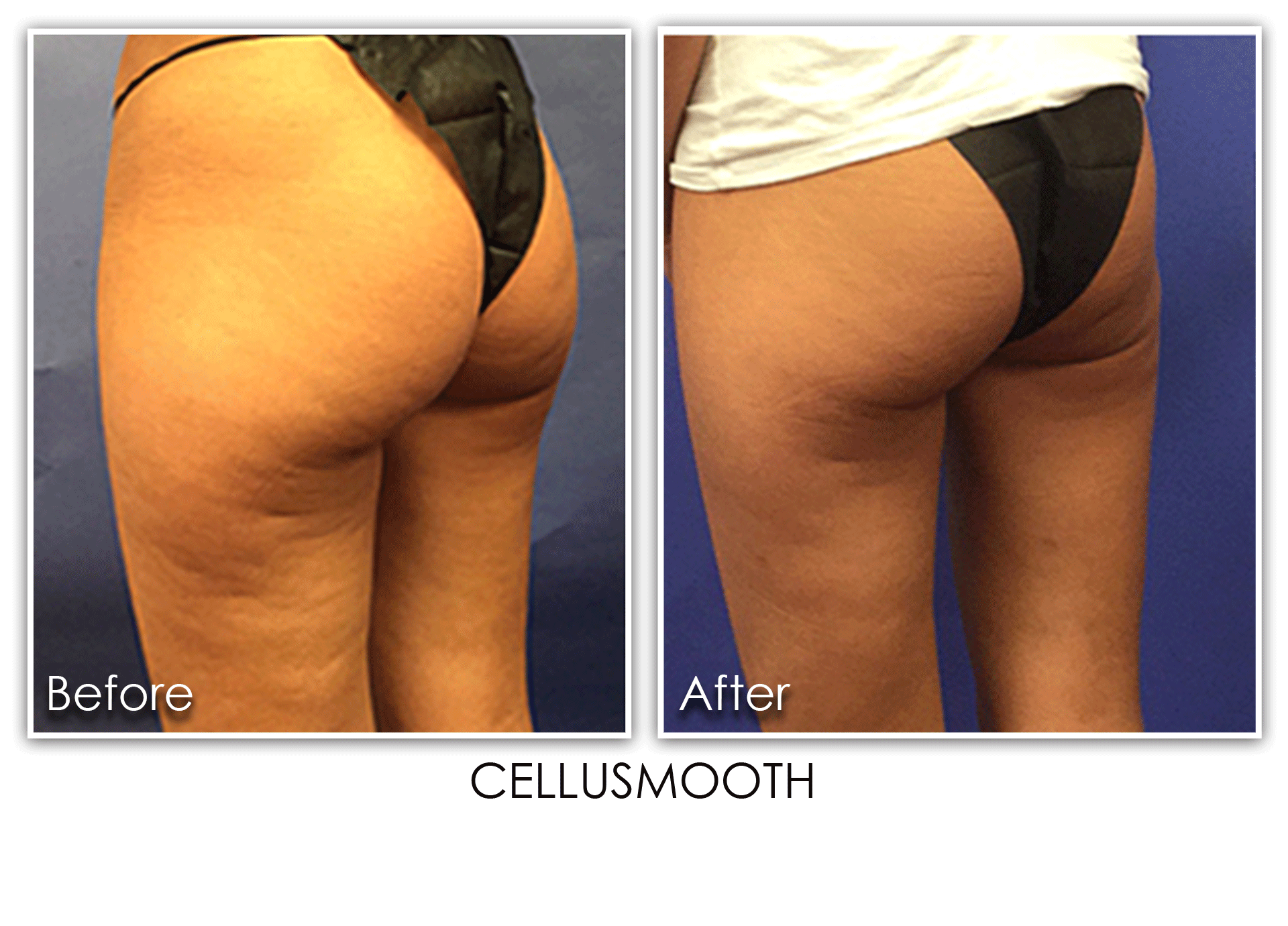 Cellulite Reduction Archives Skin Rejuvenation Clinic Skin Rejuvenation Clinic
