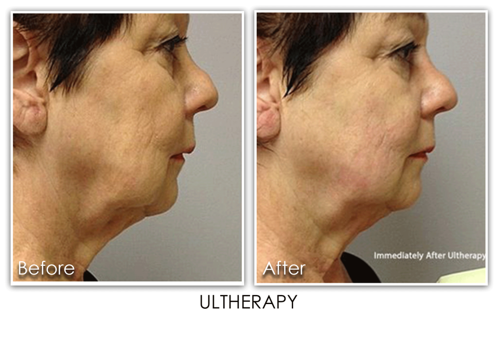 Ultherapy (NonSurgical Facelift) Skin Rejuvenation Clinic Skin