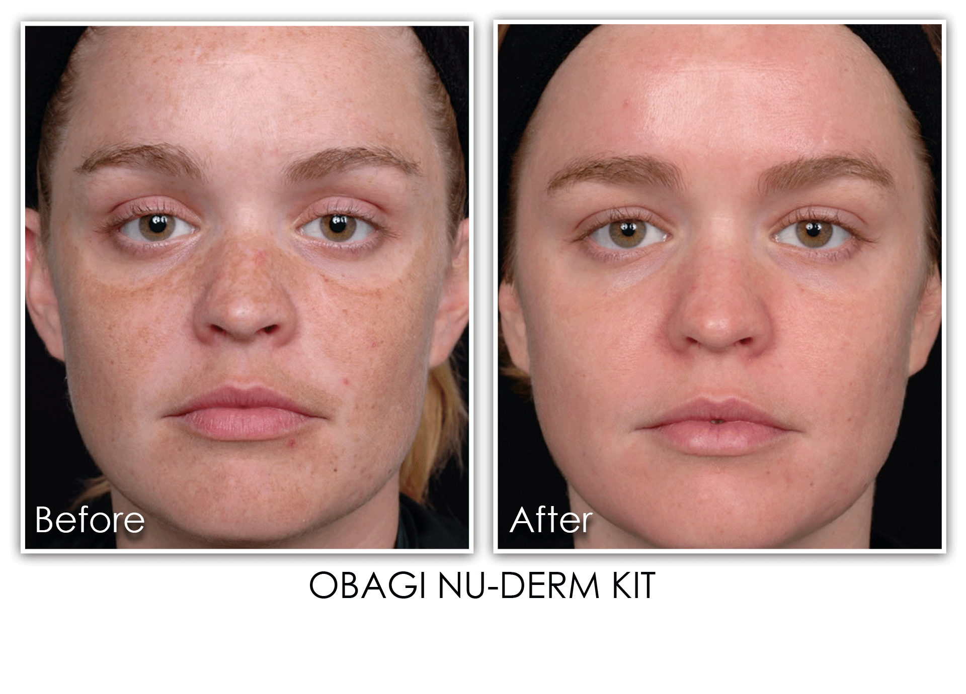 Woman before and after Obagi NU-DERM Kit Treatment