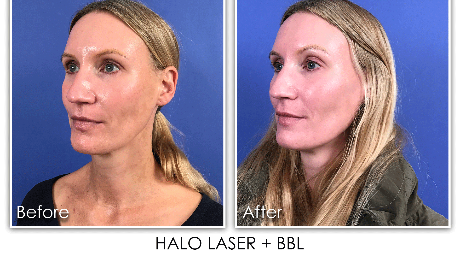 4 HALO / BBL - Skin Rejuvenation Clinic Skin Rejuvenation Clinic
