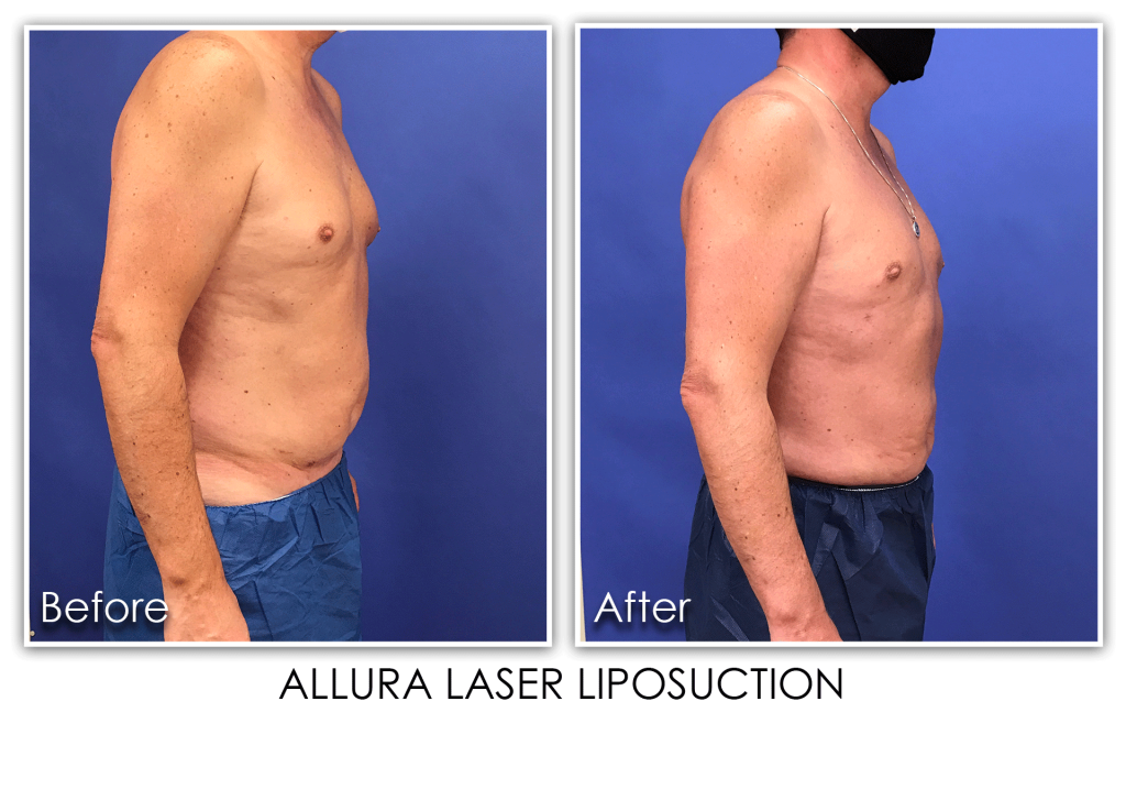 Allura Prolipo Laser Liposuction Archives Page 2 of 5 Skin