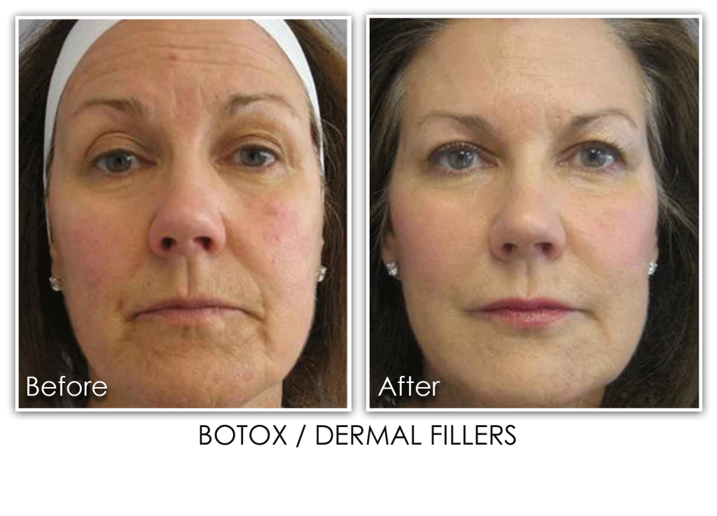 Nasolabial Fold Archives Skin Rejuvenation Clinic Skin Rejuvenation