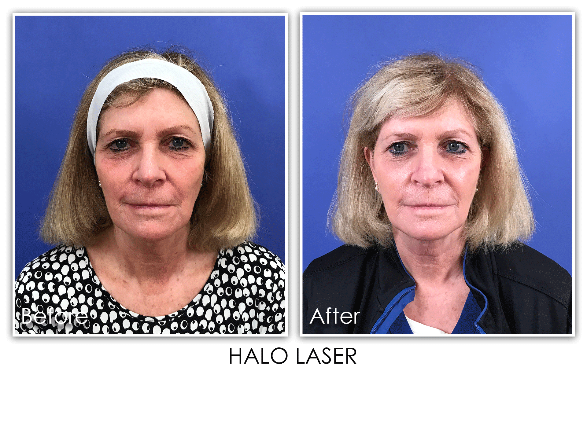 5 HALO / BBL / MLP - Skin Rejuvenation Clinic Skin Rejuvenation Clinic