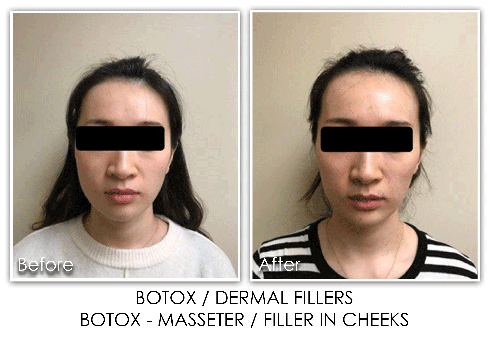 7 Botox - Skin Rejuvenation Clinic Skin Rejuvenation Clinic