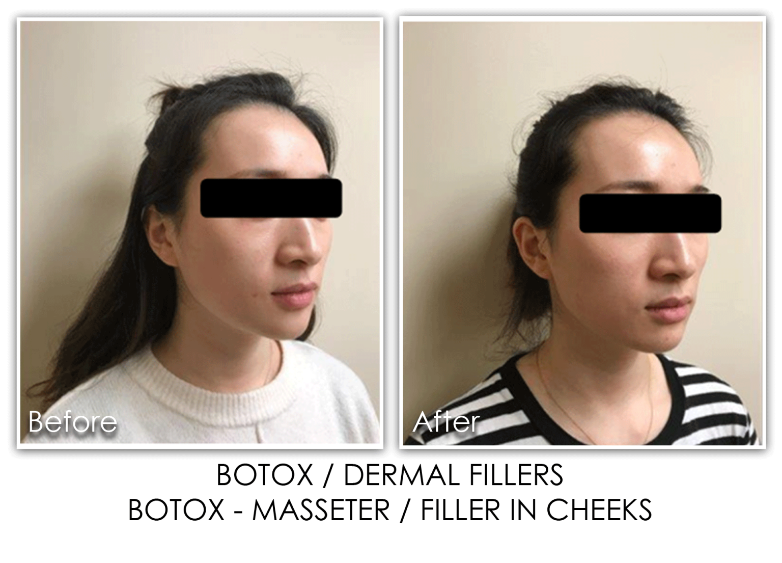 Botox Skin Rejuvenation Clinic Skin Rejuvenation Clinic