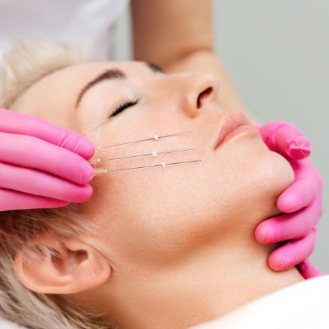 Woman receiving PDO Threading treatment
