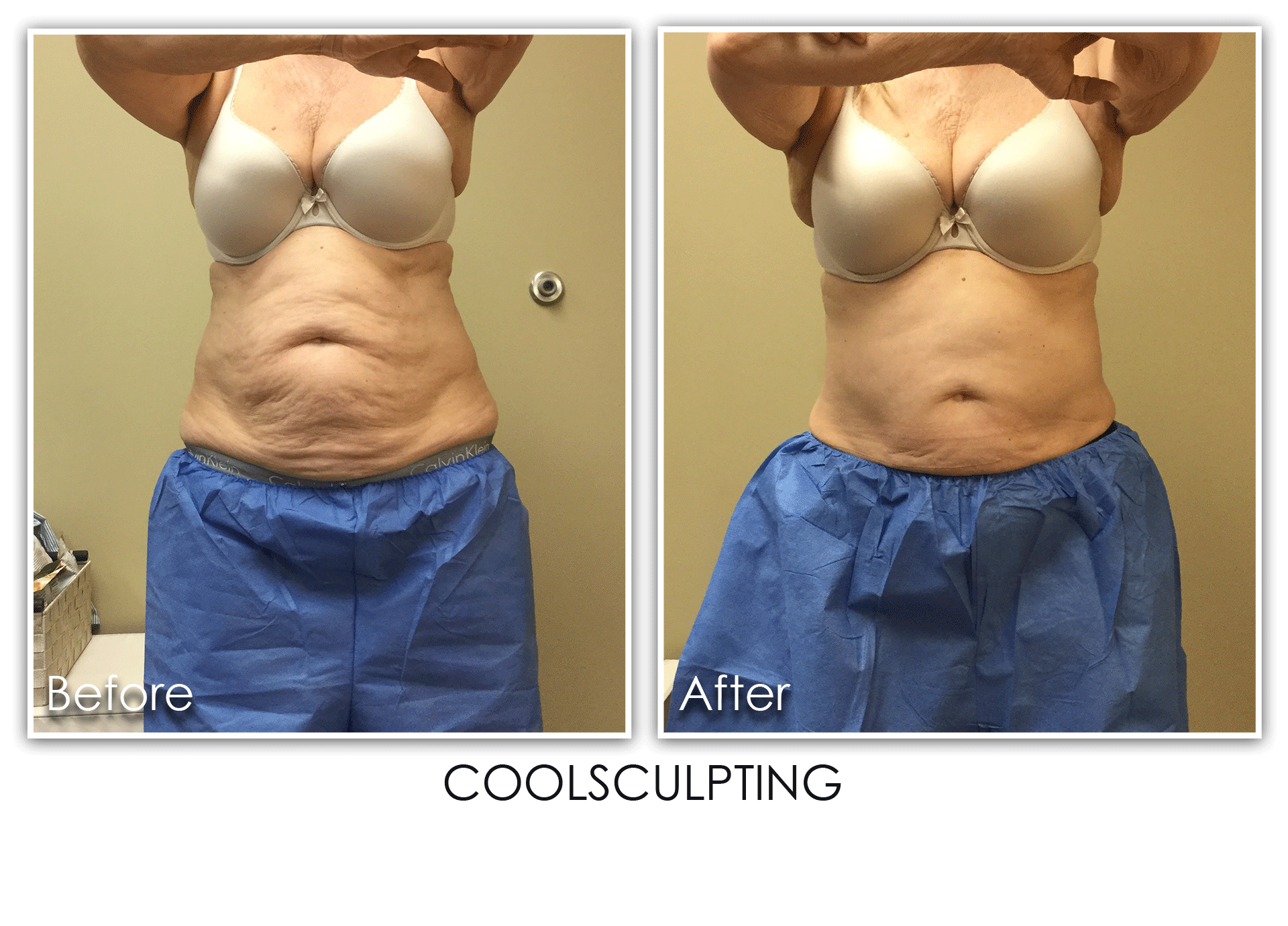 Does Coolsculpting Tighten Skin?  