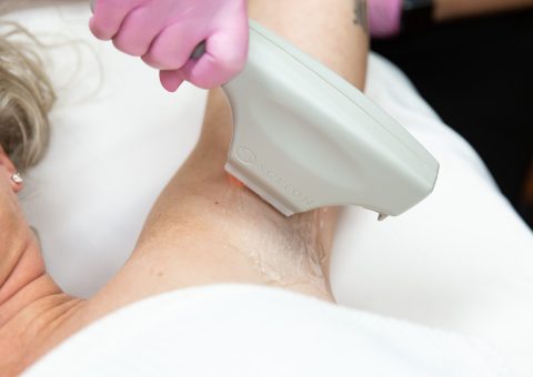 Woman receiving Laser Hair Removal Treatment