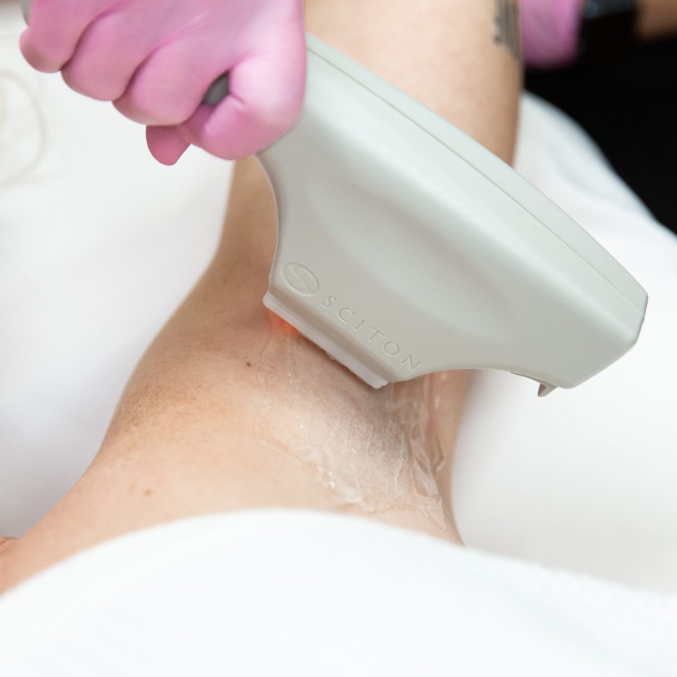 Woman receiving Laser Hair Removal Treatment