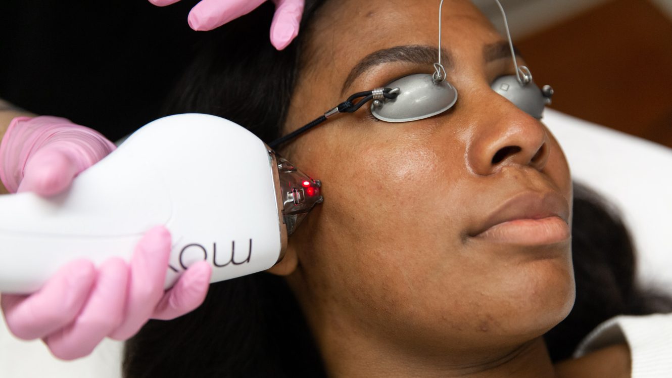 Moxi Laser treatment