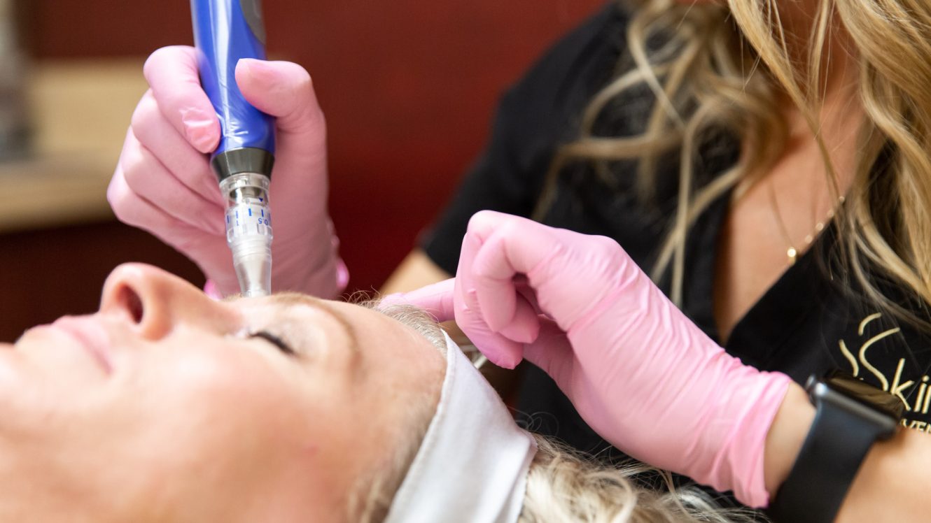 Woman receiving SkinPen treatment