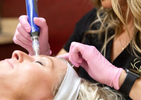 Woman receiving SkinPen treatment