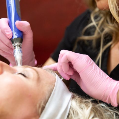 Woman receiving SkinPen treatment