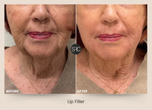 Before and after comparison of an older woman showing subtle lip filler results with improved lip definition and smoother appearance.