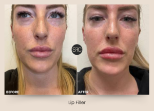 Before and after comparison showing natural looking lip filler results with improved lip volume and symmetry.