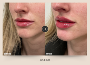 Before and after comparison of a woman showing natural looking lip filler results with increased volume and improved lip shape.