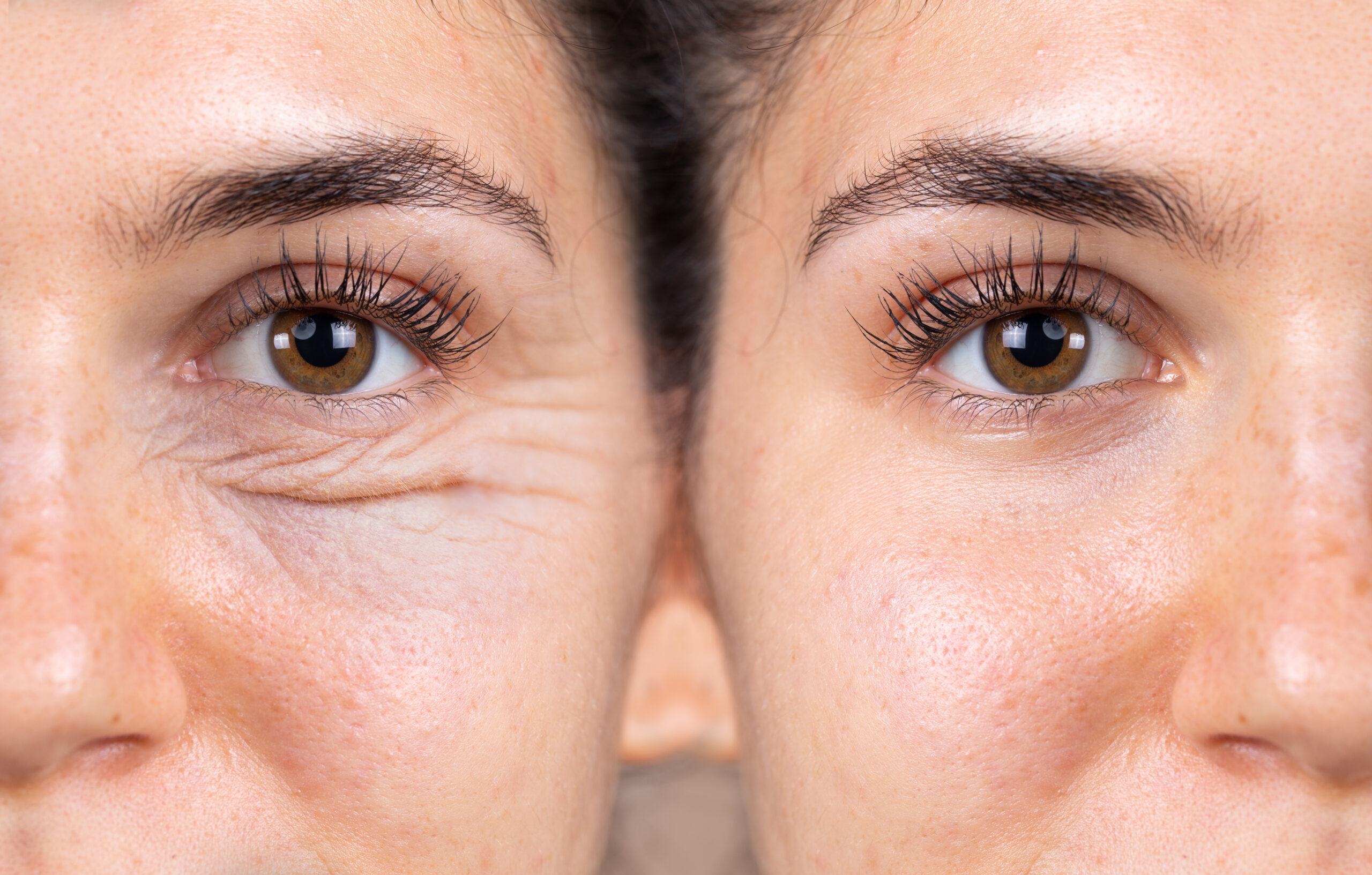 A young woman shows the before and after results of successful blepharoplasty surgery, corrective procedure to remove puffy and swollen bags beneath